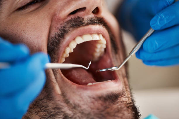 Best Emergency Tooth Extraction in Hidden Valley Lake, CA